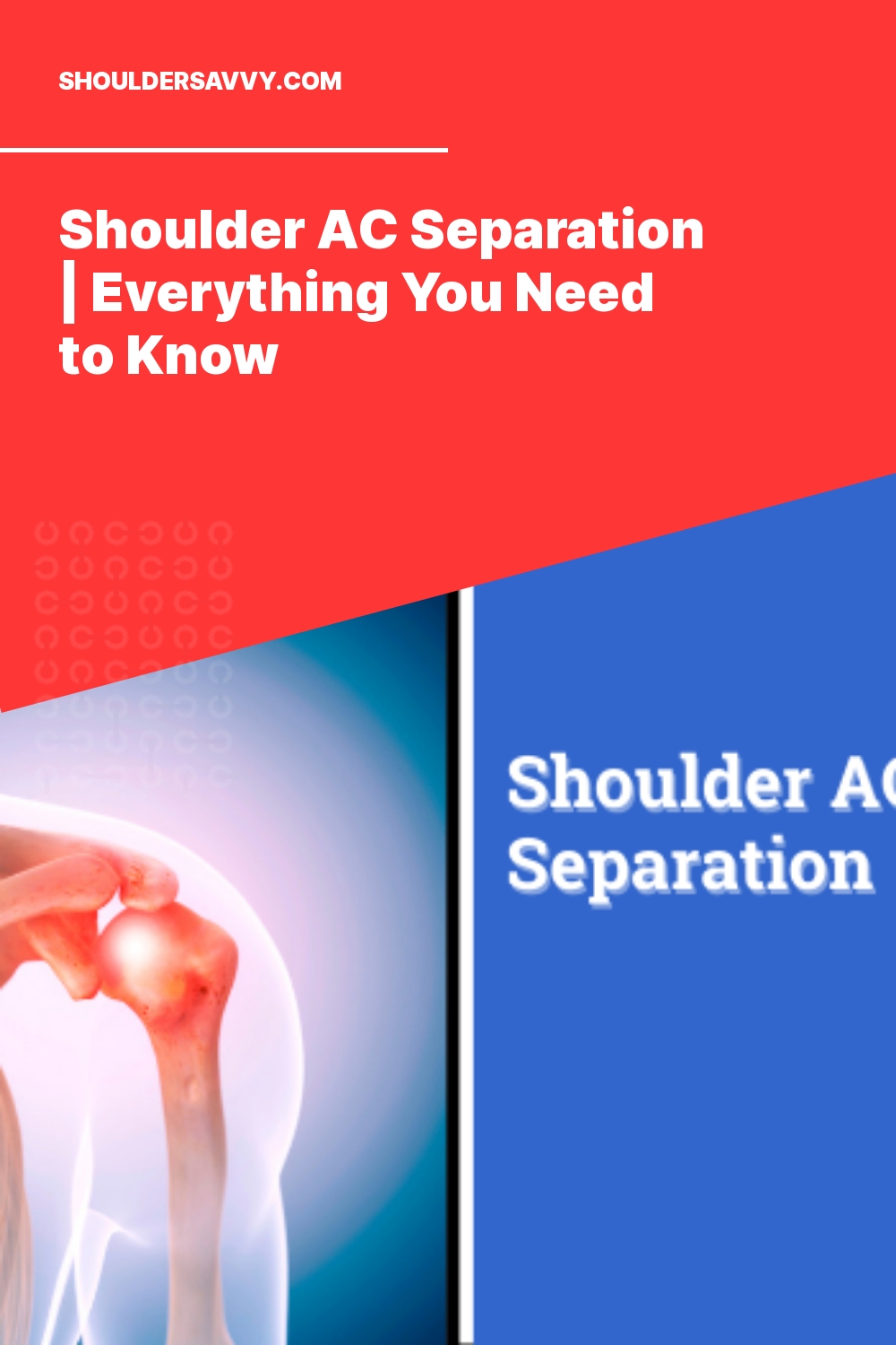 Shoulder AC Separation | Everything You Need to Know