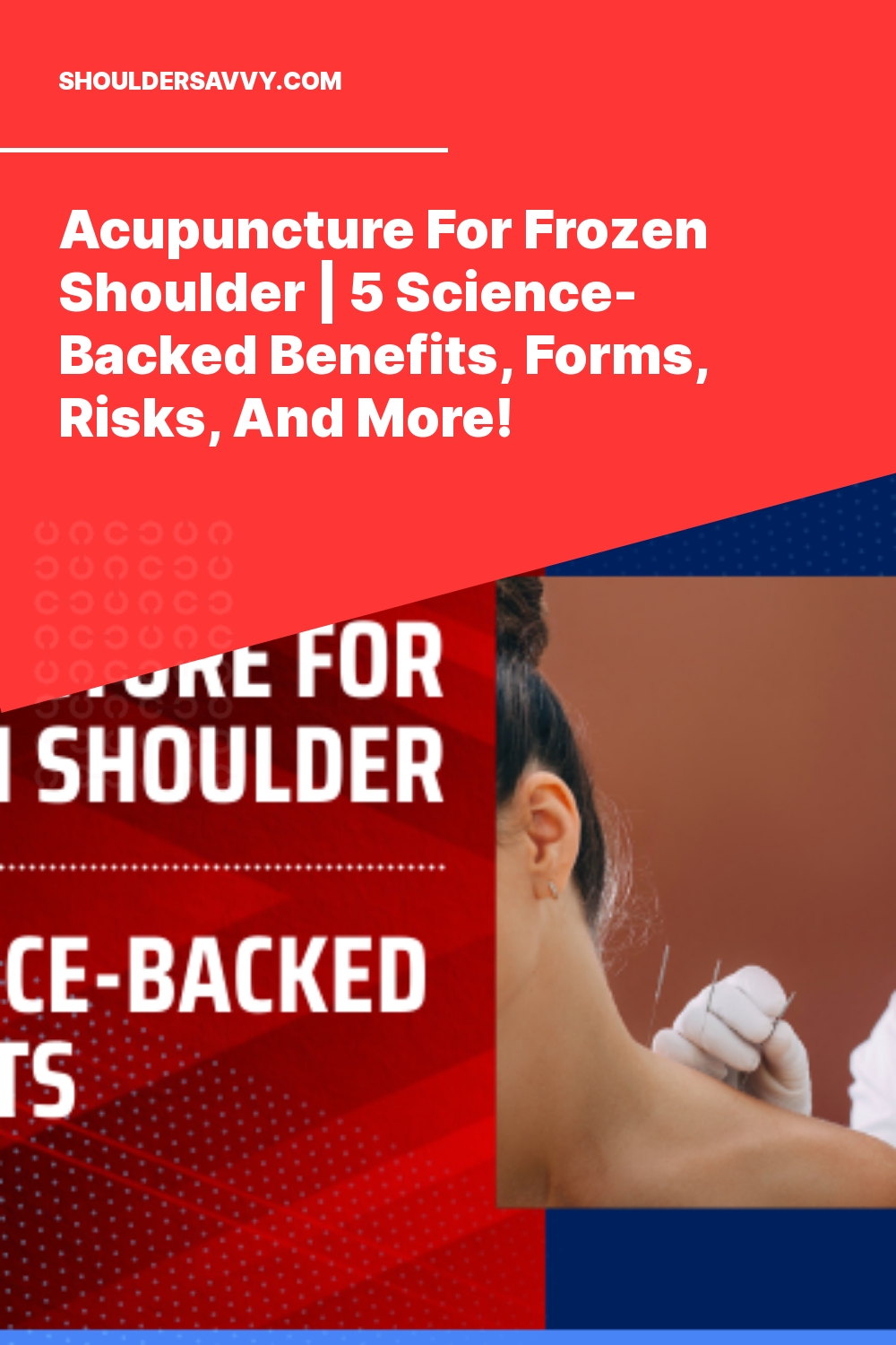Acupuncture For Frozen Shoulder | 5 Science-Backed Benefits, Forms, Risks, And More!